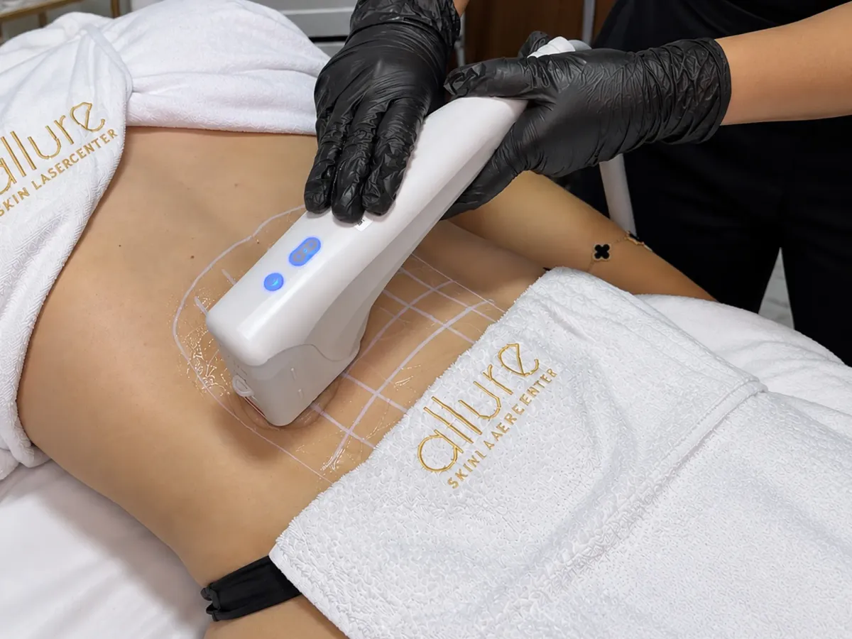 Aplicación de HIFU en el abdomen con el cabezal del equipo y la zona marcada en la piel